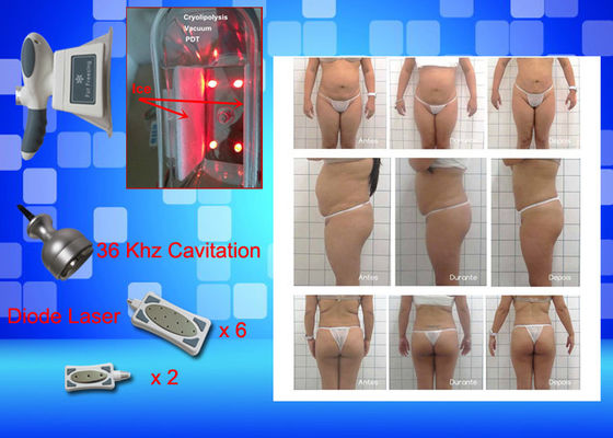 레이저 Lipo 장비 무게를 어는 Cryo는 가정 아름다움 기계를 잃습니다
